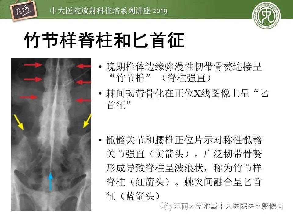 【PPT】强直性脊柱炎影像学评估