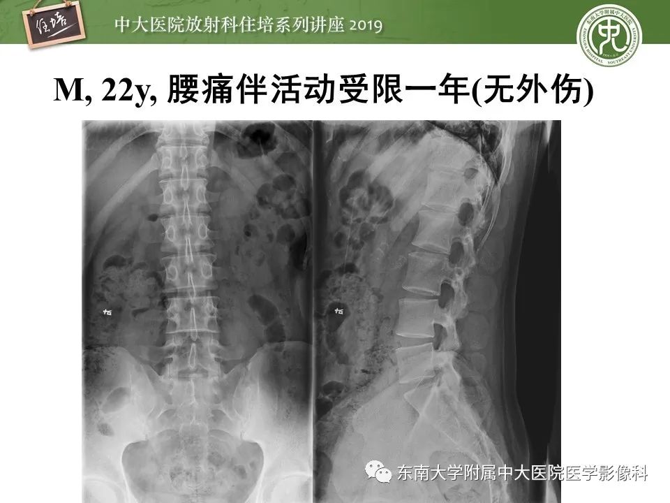 【PPT】强直性脊柱炎影像学评估