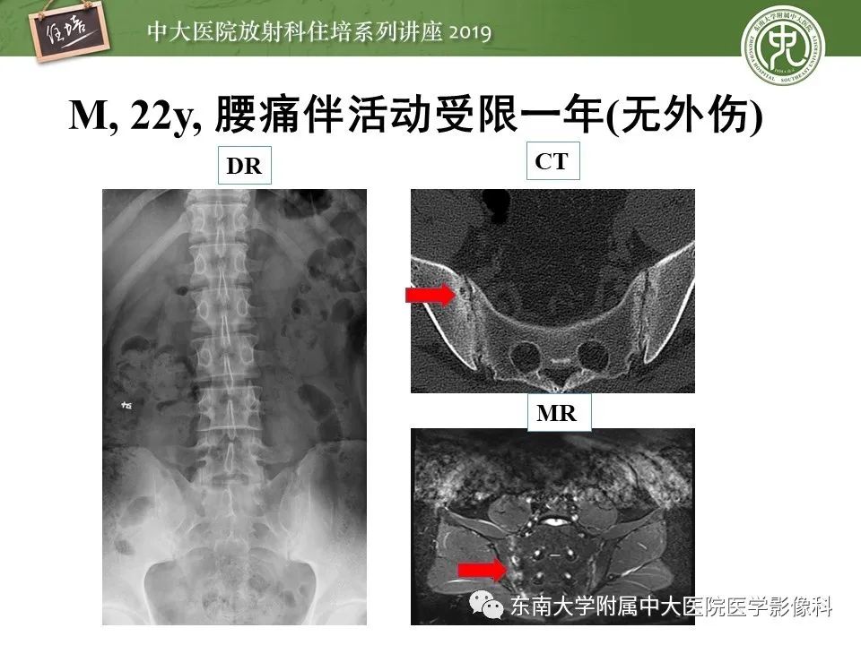 【PPT】强直性脊柱炎影像学评估