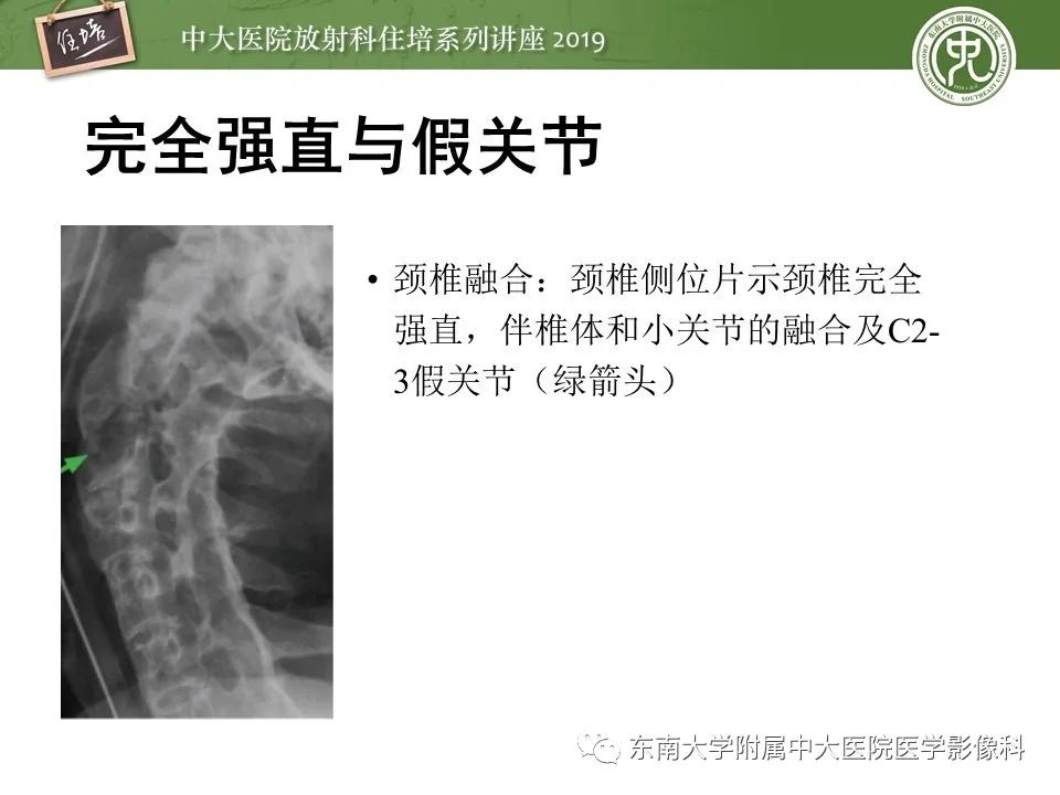 【PPT】强直性脊柱炎影像学评估