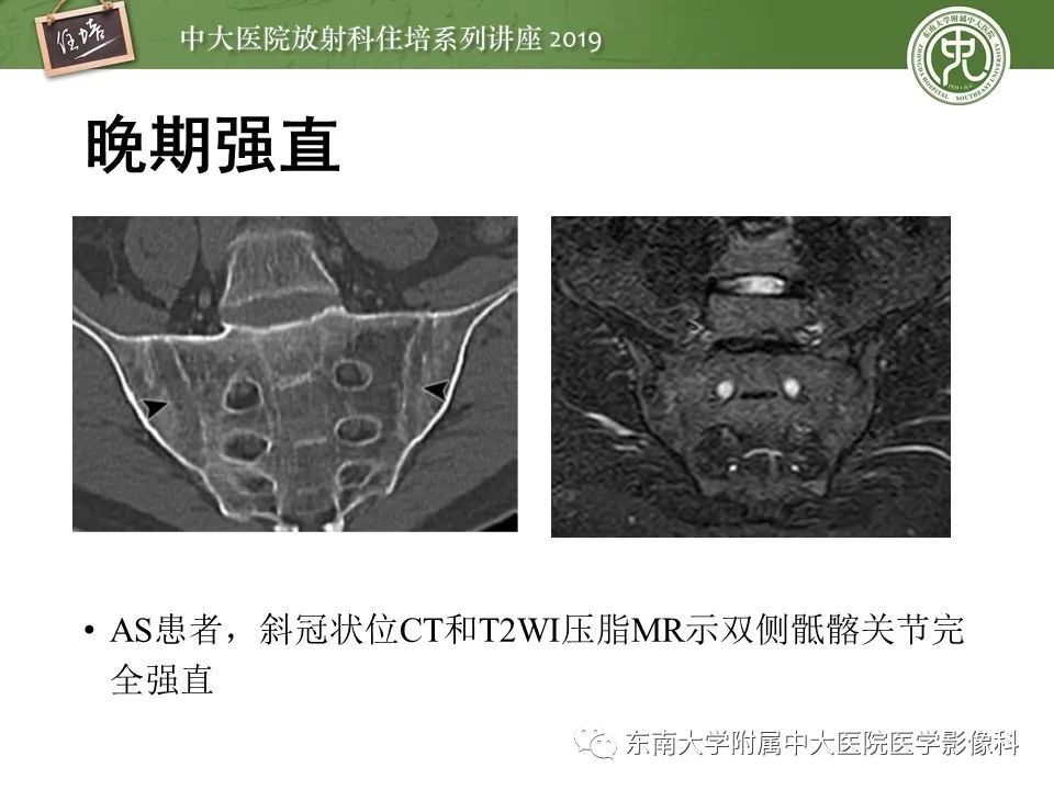 【PPT】强直性脊柱炎影像学评估