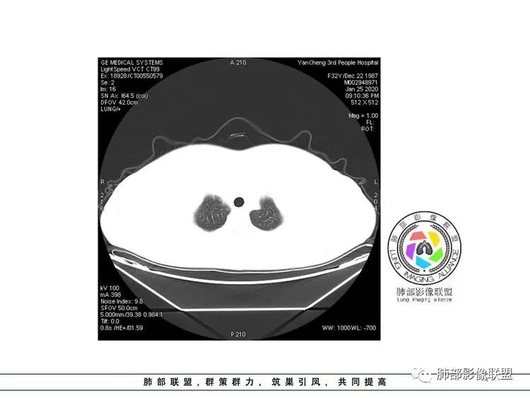 【病例】武汉归来，发热伴肺部阴影—水痘病毒性肺炎1例CT影像讨论