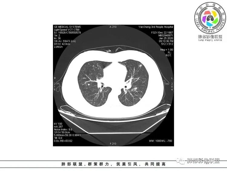 【病例】武汉归来，发热伴肺部阴影—水痘病毒性肺炎1例CT影像讨论