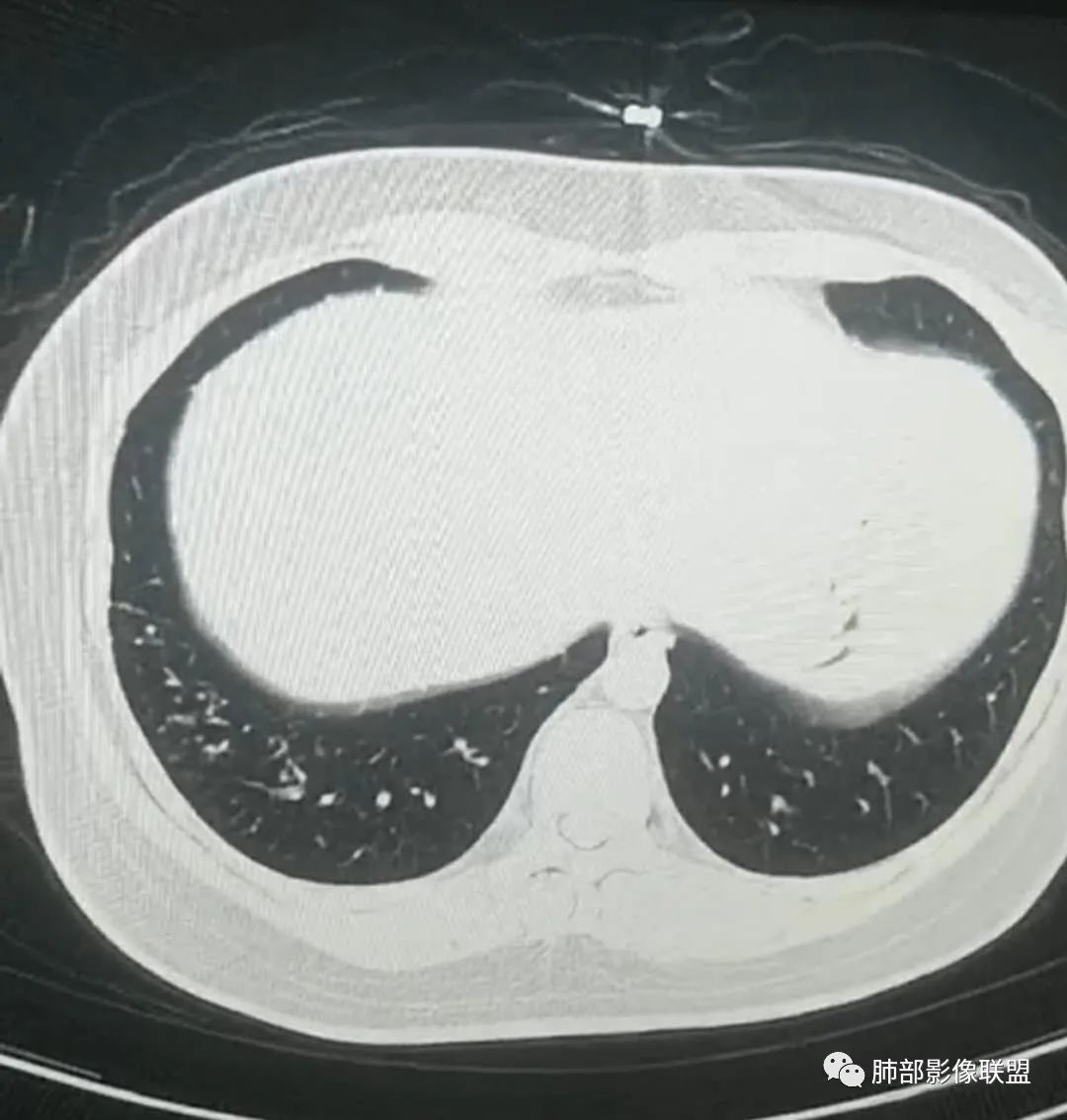 【病例】武汉归来，发热伴肺部阴影—水痘病毒性肺炎1例CT影像讨论