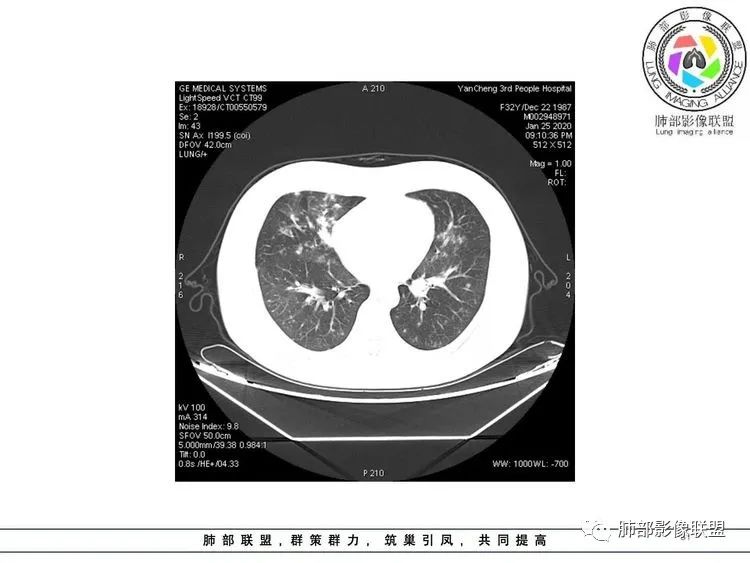 【病例】武汉归来，发热伴肺部阴影—水痘病毒性肺炎1例CT影像讨论