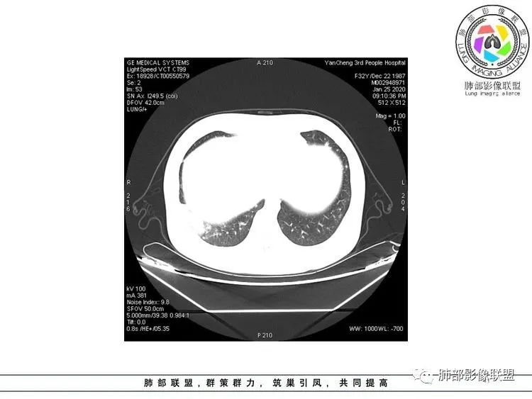 【病例】武汉归来，发热伴肺部阴影—水痘病毒性肺炎1例CT影像讨论
