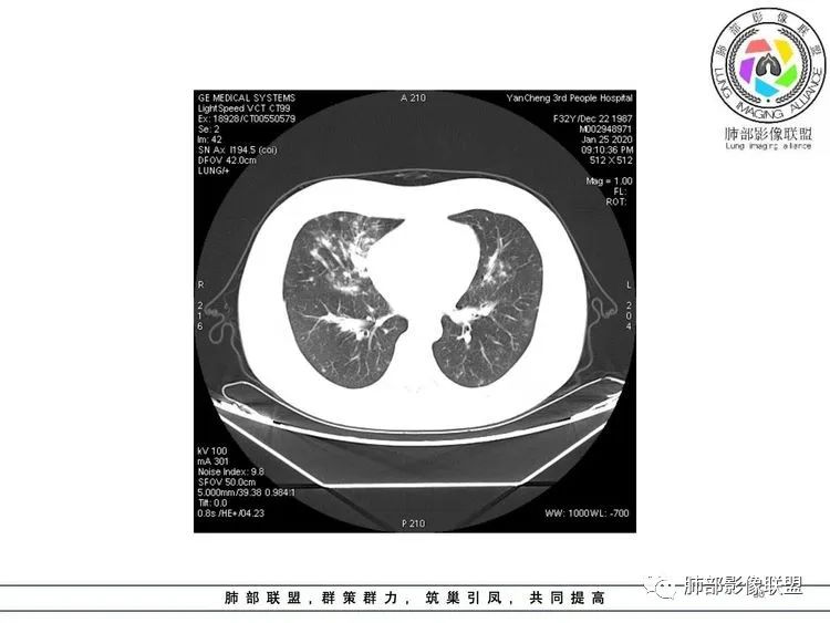 【病例】武汉归来，发热伴肺部阴影—水痘病毒性肺炎1例CT影像讨论