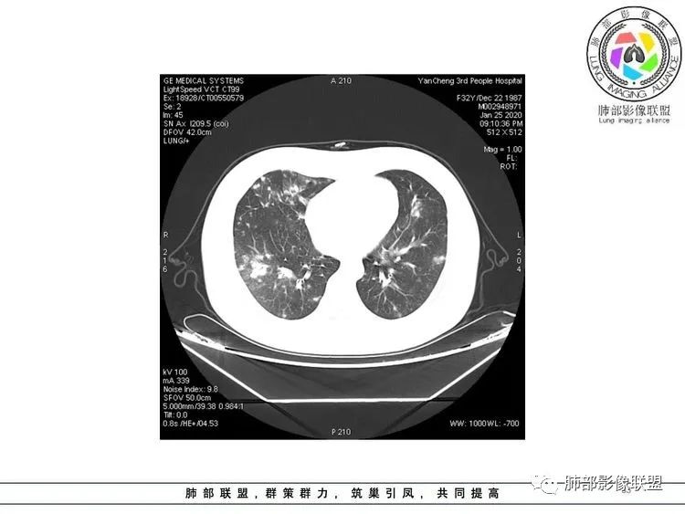 【病例】武汉归来，发热伴肺部阴影—水痘病毒性肺炎1例CT影像讨论