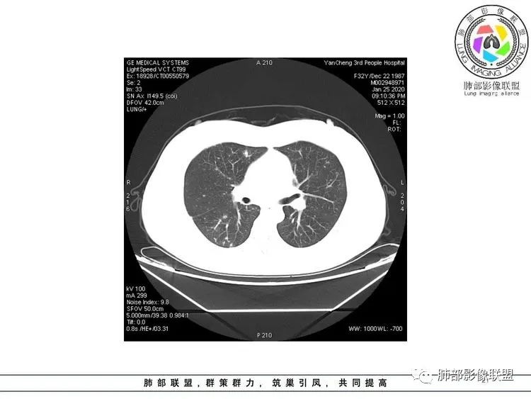 【病例】武汉归来，发热伴肺部阴影—水痘病毒性肺炎1例CT影像讨论