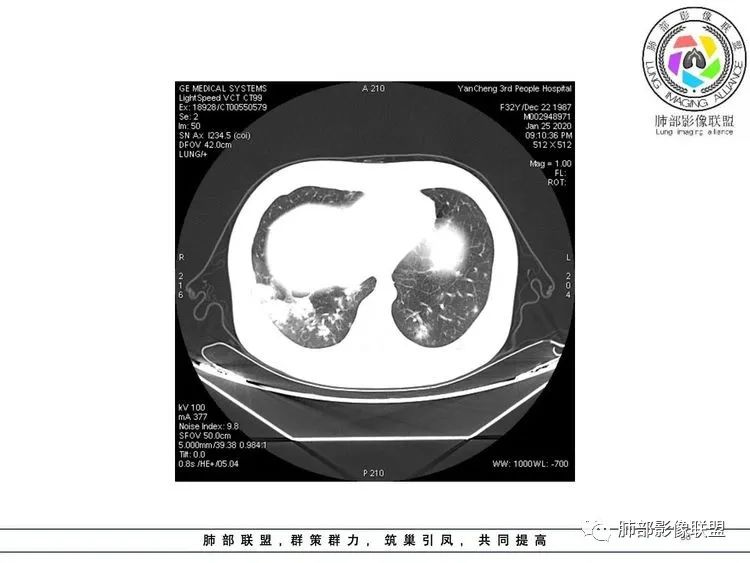 【病例】武汉归来，发热伴肺部阴影—水痘病毒性肺炎1例CT影像讨论