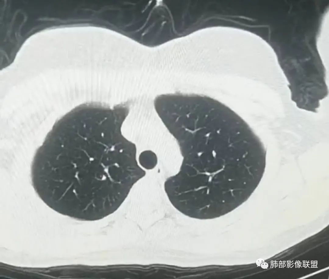 【病例】武汉归来，发热伴肺部阴影—水痘病毒性肺炎1例CT影像讨论