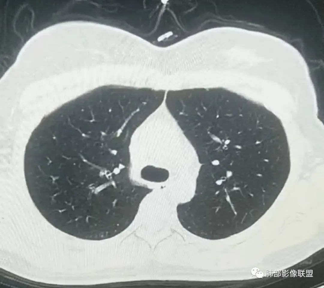 【病例】武汉归来，发热伴肺部阴影—水痘病毒性肺炎1例CT影像讨论