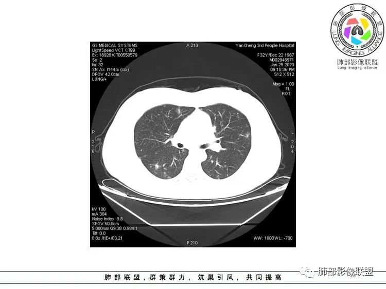 【病例】武汉归来，发热伴肺部阴影—水痘病毒性肺炎1例CT影像讨论