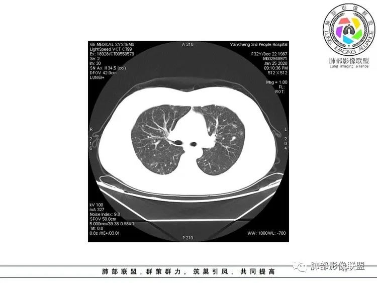 【病例】武汉归来，发热伴肺部阴影—水痘病毒性肺炎1例CT影像讨论