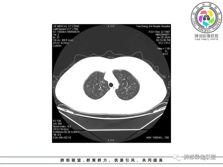 【病例】武汉归来，发热伴肺部阴影—水痘病毒性肺炎1例CT影像讨论