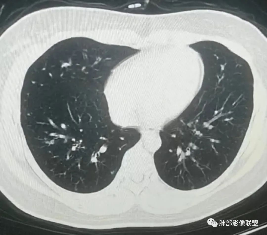 【病例】武汉归来，发热伴肺部阴影—水痘病毒性肺炎1例CT影像讨论