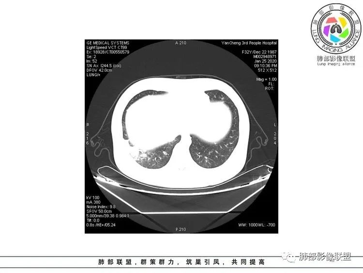 【病例】武汉归来，发热伴肺部阴影—水痘病毒性肺炎1例CT影像讨论