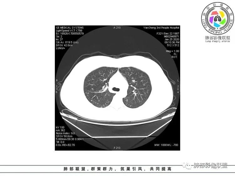 【病例】武汉归来，发热伴肺部阴影—水痘病毒性肺炎1例CT影像讨论
