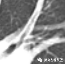 【病例】武汉归来，发热伴肺部阴影—水痘病毒性肺炎1例CT影像讨论