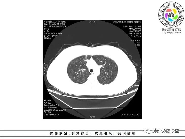 【病例】武汉归来，发热伴肺部阴影—水痘病毒性肺炎1例CT影像讨论