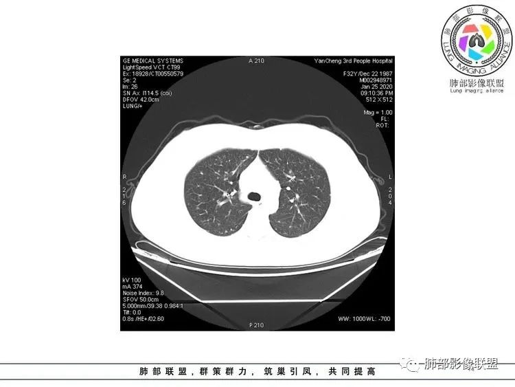 【病例】武汉归来，发热伴肺部阴影—水痘病毒性肺炎1例CT影像讨论