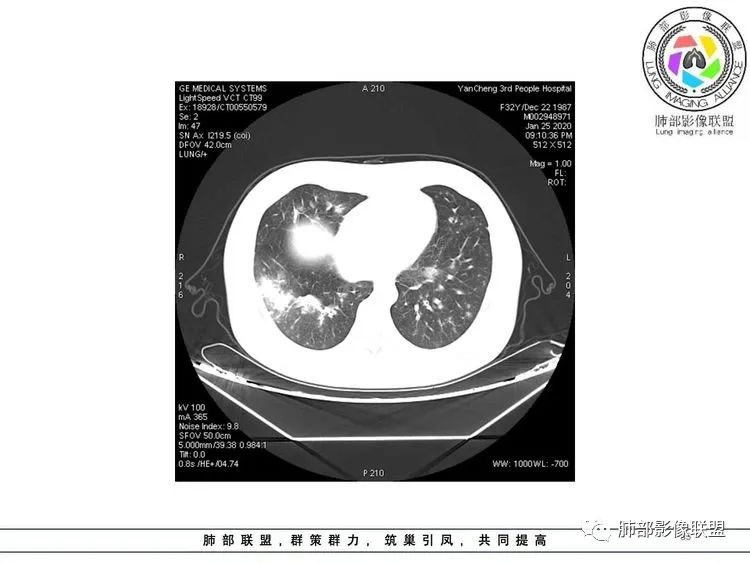 【病例】武汉归来，发热伴肺部阴影—水痘病毒性肺炎1例CT影像讨论