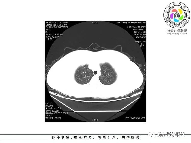 【病例】武汉归来，发热伴肺部阴影—水痘病毒性肺炎1例CT影像讨论