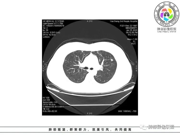 【病例】武汉归来，发热伴肺部阴影—水痘病毒性肺炎1例CT影像讨论