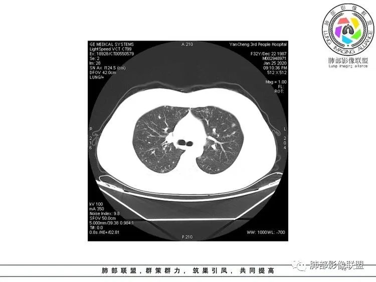 【病例】武汉归来，发热伴肺部阴影—水痘病毒性肺炎1例CT影像讨论
