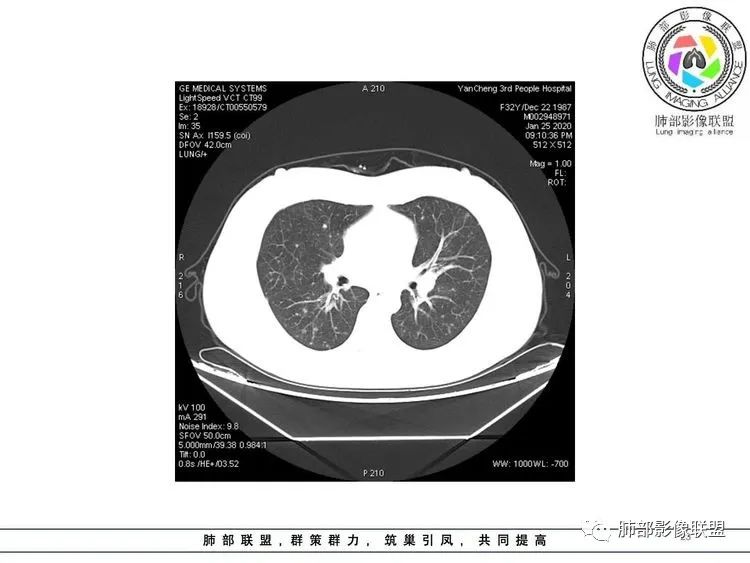 【病例】武汉归来，发热伴肺部阴影—水痘病毒性肺炎1例CT影像讨论