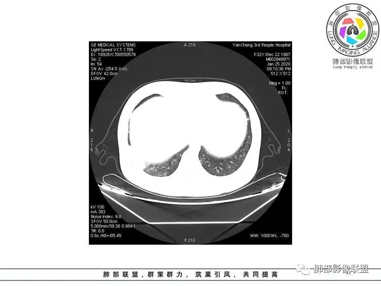 【病例】武汉归来，发热伴肺部阴影—水痘病毒性肺炎1例CT影像讨论