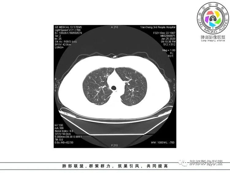 【病例】武汉归来，发热伴肺部阴影—水痘病毒性肺炎1例CT影像讨论