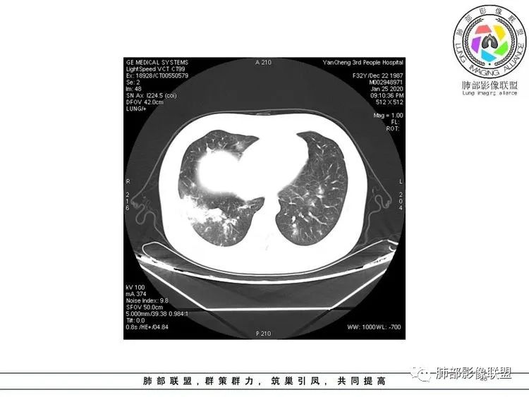 【病例】武汉归来，发热伴肺部阴影—水痘病毒性肺炎1例CT影像讨论