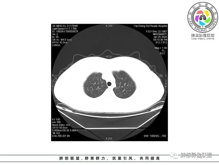 【病例】武汉归来，发热伴肺部阴影—水痘病毒性肺炎1例CT影像讨论