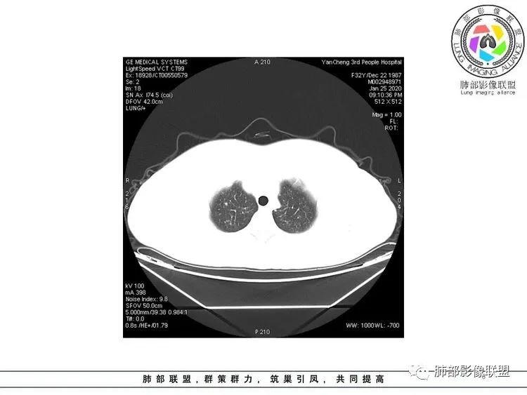 【病例】武汉归来，发热伴肺部阴影—水痘病毒性肺炎1例CT影像讨论