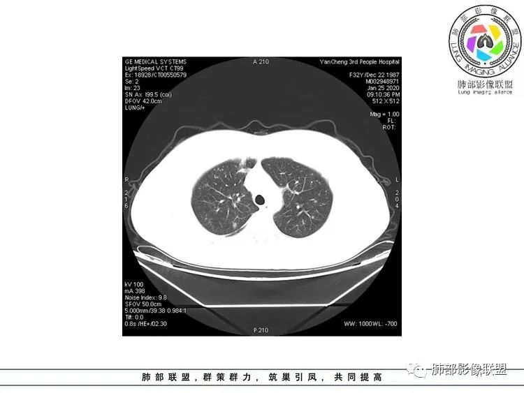 【病例】武汉归来，发热伴肺部阴影—水痘病毒性肺炎1例CT影像讨论