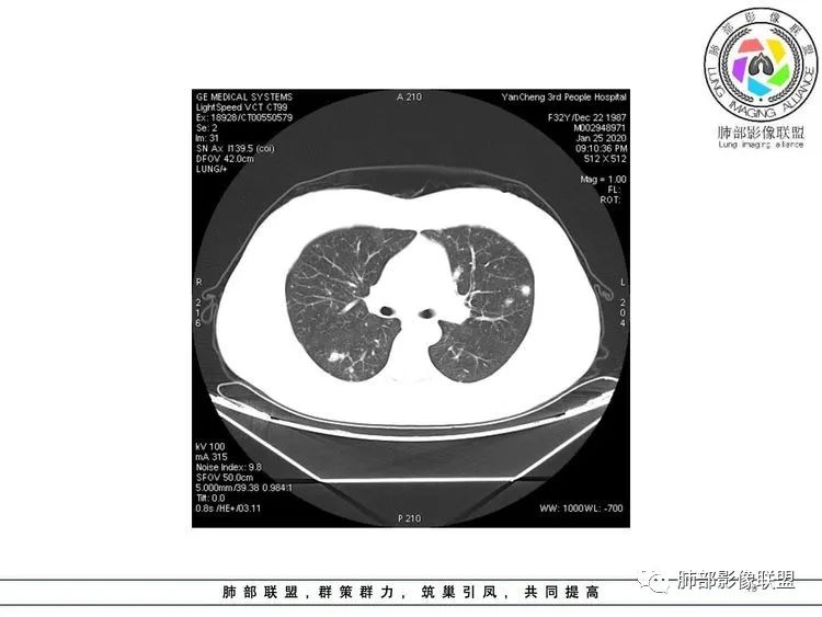 【病例】武汉归来，发热伴肺部阴影—水痘病毒性肺炎1例CT影像讨论