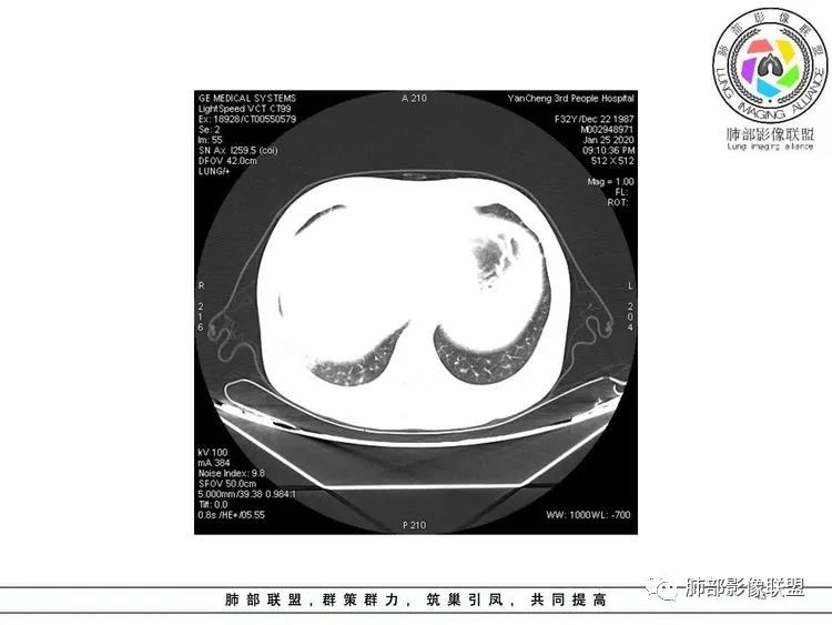 【病例】武汉归来，发热伴肺部阴影—水痘病毒性肺炎1例CT影像讨论