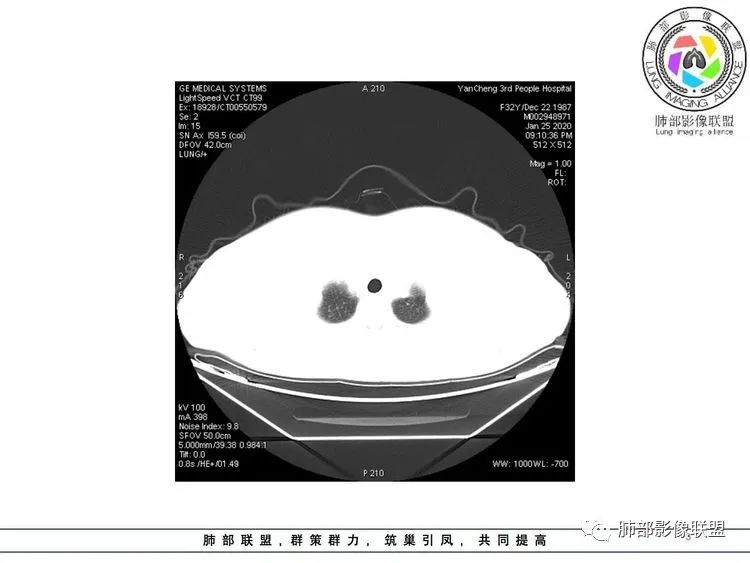 【病例】武汉归来，发热伴肺部阴影—水痘病毒性肺炎1例CT影像讨论