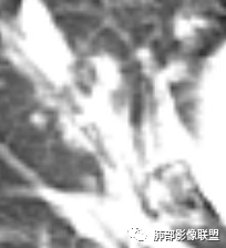 【病例】武汉归来，发热伴肺部阴影—水痘病毒性肺炎1例CT影像讨论