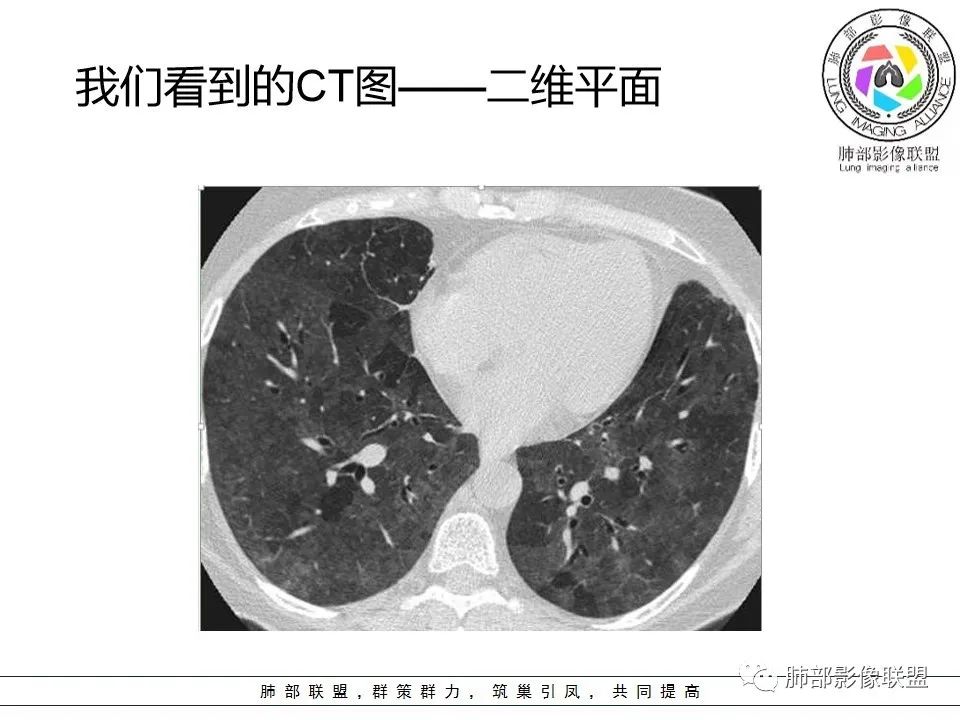 【PPT】如何快速掌握新冠肺炎（NCP）的影像识别？