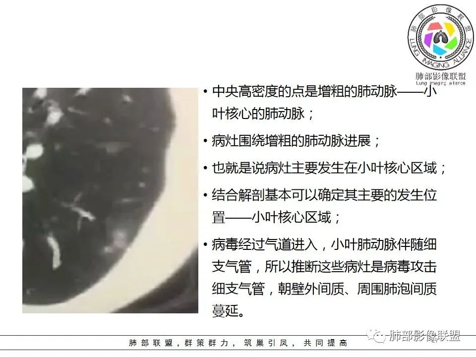 【PPT】如何快速掌握新冠肺炎（NCP）的影像识别？