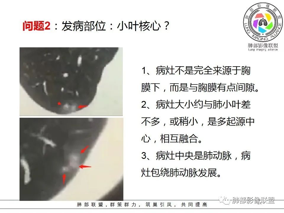 【PPT】如何快速掌握新冠肺炎（NCP）的影像识别？