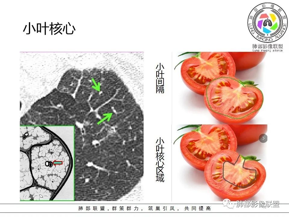 【PPT】如何快速掌握新冠肺炎（NCP）的影像识别？