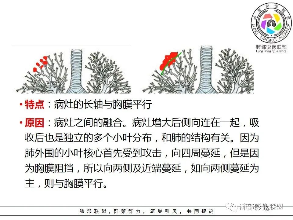 【PPT】如何快速掌握新冠肺炎（NCP）的影像识别？