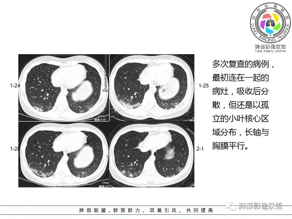 【PPT】如何快速掌握新冠肺炎（NCP）的影像识别？