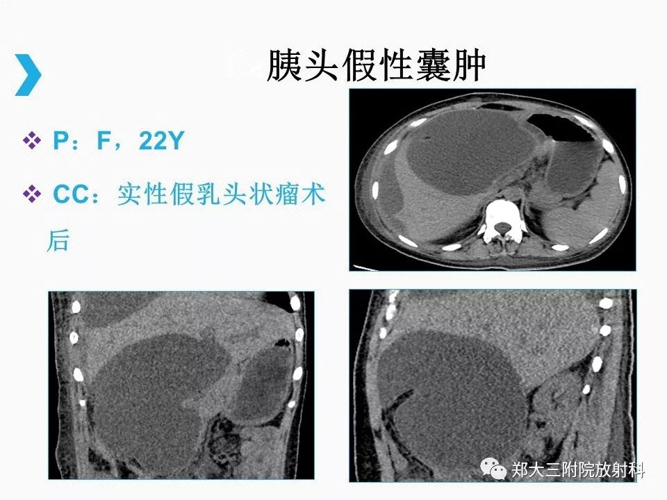 【PPT】小儿先天性胆总管囊肿CT诊断 【PPT】小儿先天性胆总管囊肿CT诊断