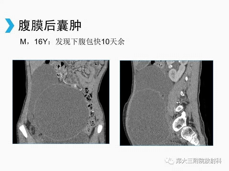 【PPT】小儿先天性胆总管囊肿CT诊断 【PPT】小儿先天性胆总管囊肿CT诊断