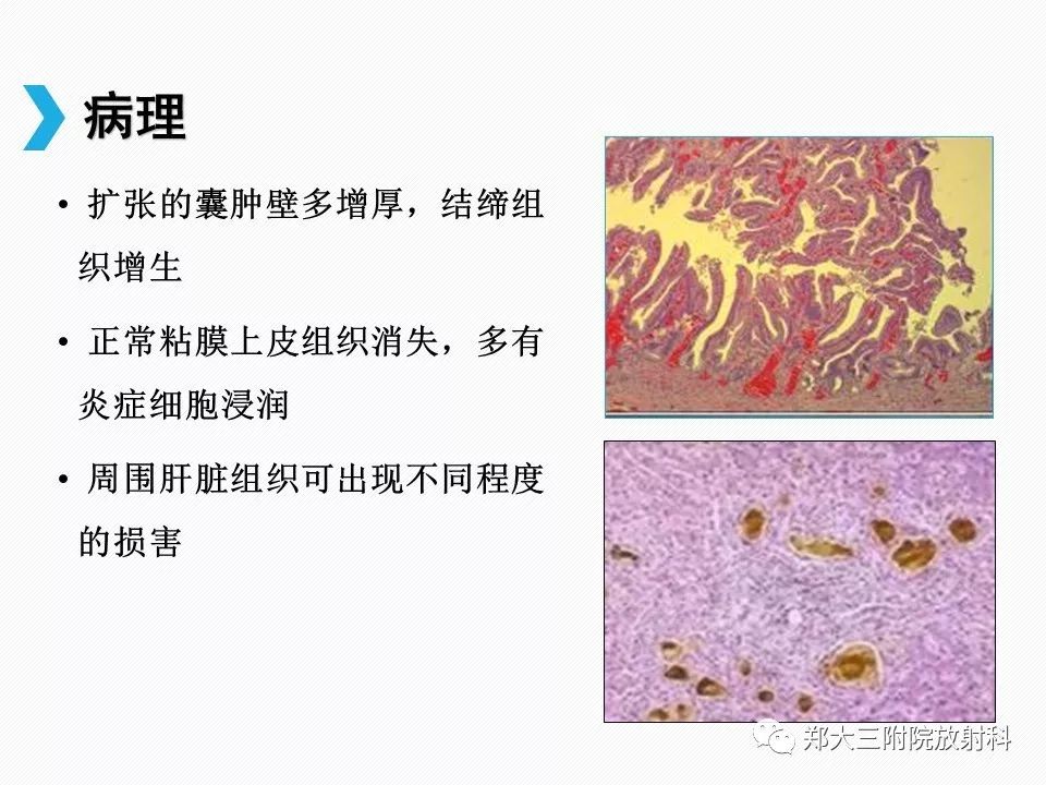 【PPT】小儿先天性胆总管囊肿CT诊断 【PPT】小儿先天性胆总管囊肿CT诊断