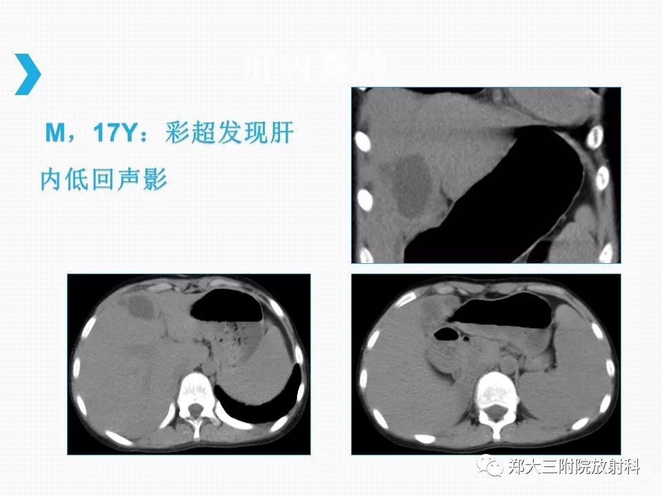 【PPT】小儿先天性胆总管囊肿CT诊断 【PPT】小儿先天性胆总管囊肿CT诊断